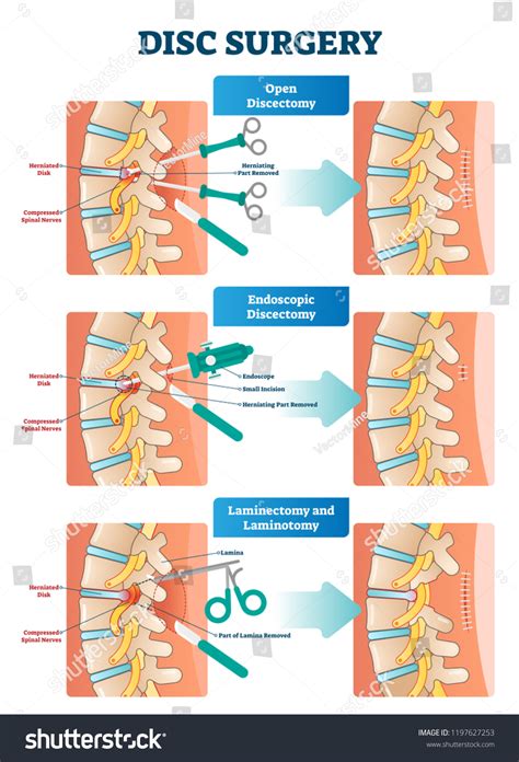 717 Laminectomy Images, Stock Photos & Vectors | Shutterstock