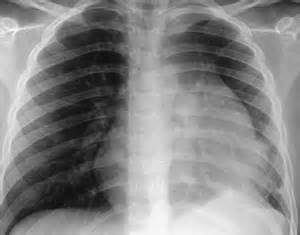 109 Mediastinal Mass Biopsy | Radiology Key