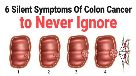 6 Silent Symptoms Of Colon Cancer to Never Ignore - Health Queen