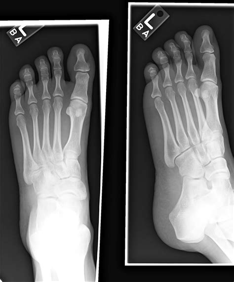 NORMAL FOOT 5 - Buyxraysonline