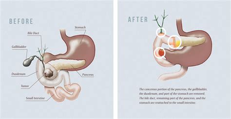 A complex and lifesaving surgery for pancreatic cancer