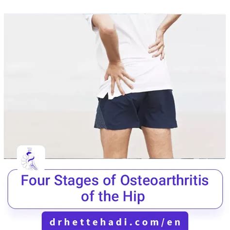 Four Stages of Osteoarthritis of the Hip - Dr. Hossein Ettehadi