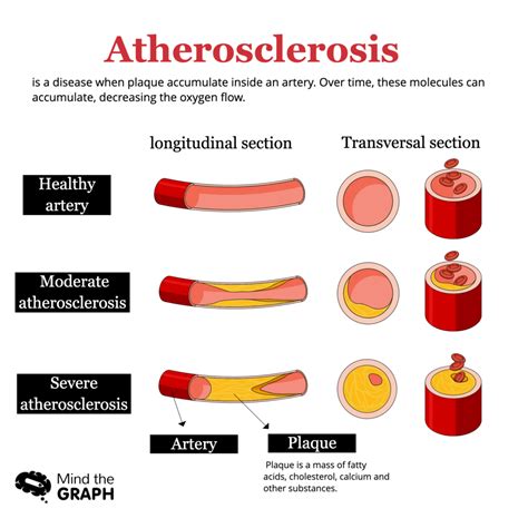 Understanding atherosclerosis through medical illustrations - Mind the ...