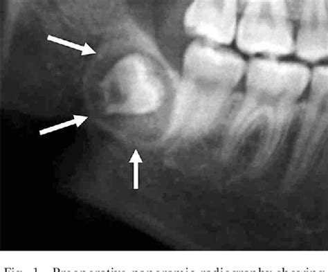 Figure 1 from Adenomatoid odontogenic tumor arising from the mandibular ...