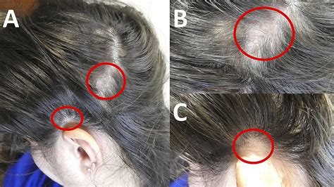 Systemic Lupus Erythematosus Presenting as Alopecia Areata | Cureus