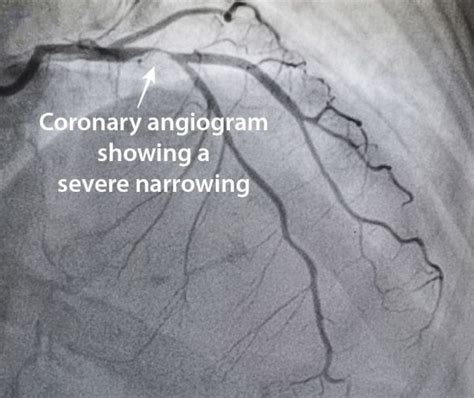 Coronary Angiography - Capital Heart Centre