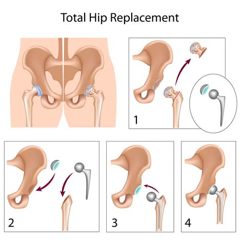 Total-hip-replacement-surgery