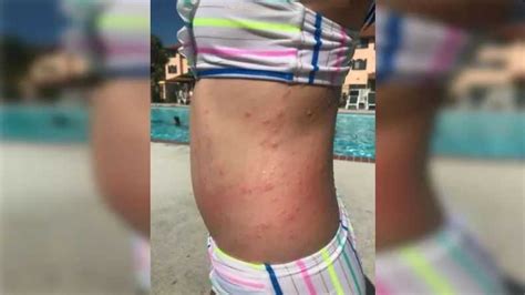 Mother believes sea lice from Carolina Beach caused irritating rash