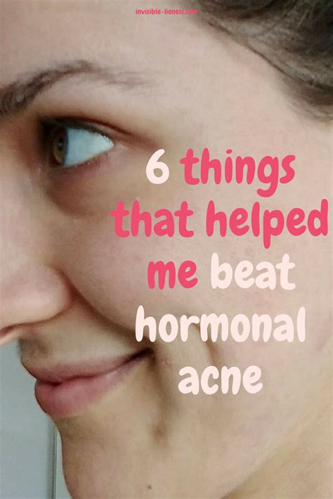 I beat hormonal acne: My 6 powerful little secrets | Hormonal acne ...