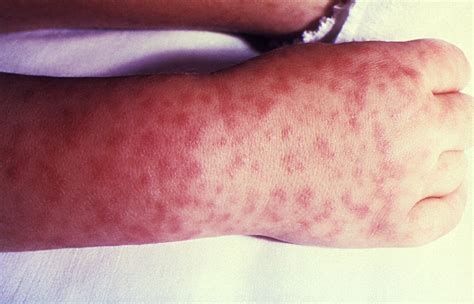 Lyme Disease Tick Bite Rash