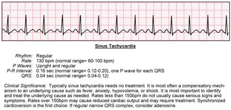 Tachycardia ECG - ACLS Wiki