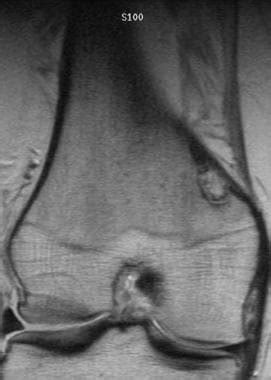 Fibrous Cortical Defect and Nonossifying Fibroma Imaging: Practice ...