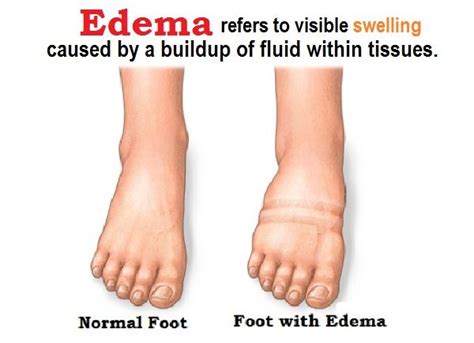 Pin on Edema