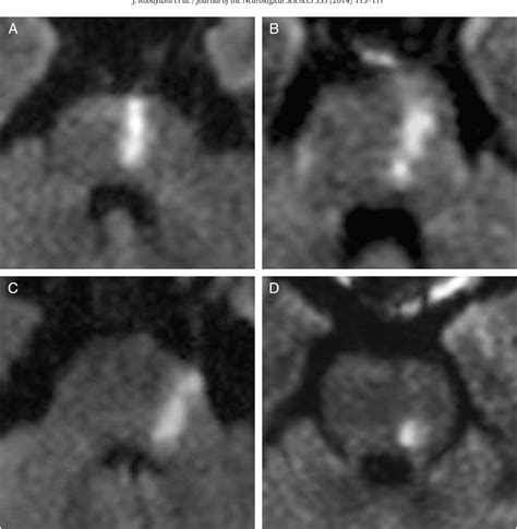 Etiological mechanisms of isolated pontine infarcts based on arterial ...