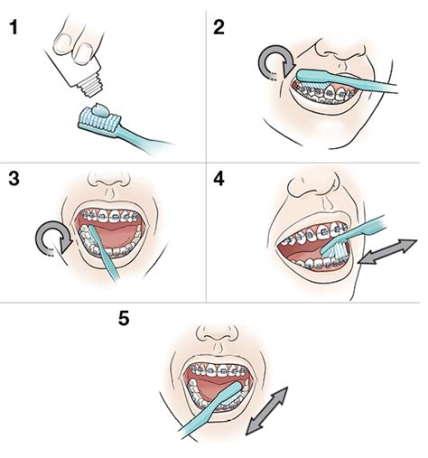 Step-by-Step: Brushing Your Teeth and Braces | Saint Luke's Health System