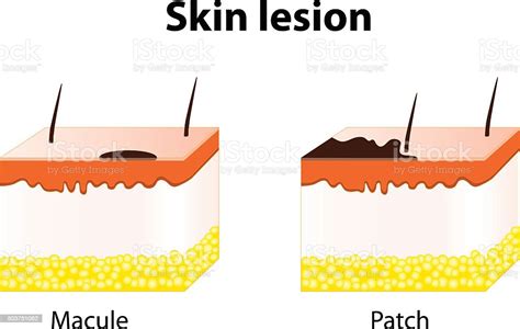 Macule And Patch Types Of Skin Lesions Stock Illustration - Download ...