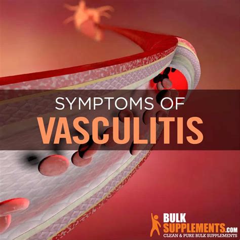 Vasculitis Treatment