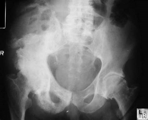 Learning Radiology - Osteosarcoma in Paget Disease