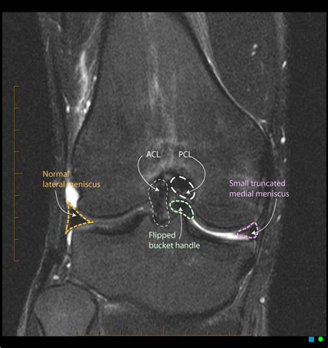 Bucket handle medial meniscus tear | Radiology Case | Radiopaedia.org ...