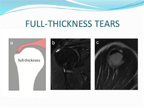 Figure 3 from Tears at the rotator cuff footprints: imaging ...