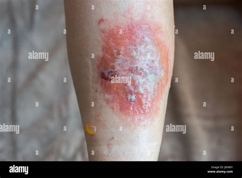 Poison Ivy rash and blisters on a leg Stock Photo - Alamy