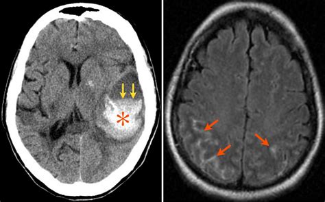 surgery: Brain hemorrhage