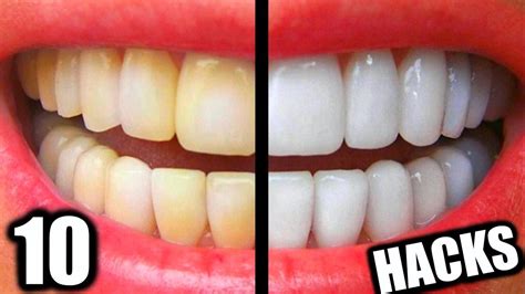 Teeth Whitening Hacks That Actually Work