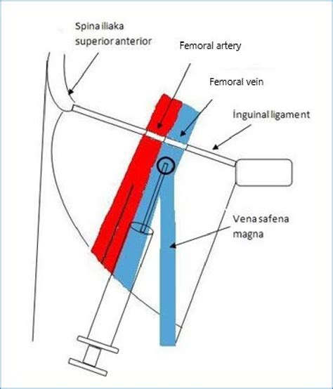 9: Femoral venous catheterization. | Download Scientific Diagram