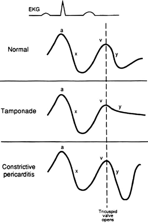 Jugular Venous Pulse and Pressure (JVP) Examination | Epomedicine