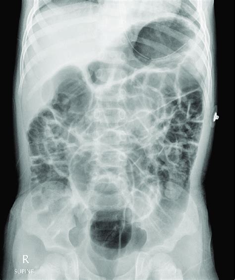 Abdominal radiography illustrating a paralytic ileus pattern ...