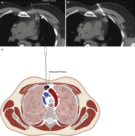 Biopsy of Mediastinal Lesions | Radiology Key