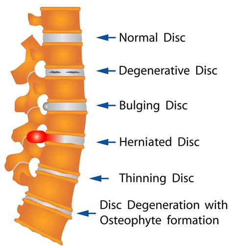 Bulging Disc - Dr. Paul C. McCormick