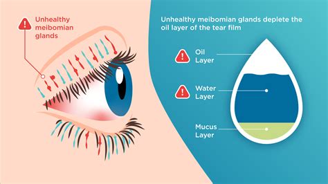 Dry Eye Treatment | Dry Eye Syndrome | Dry Eyes | Optometrist