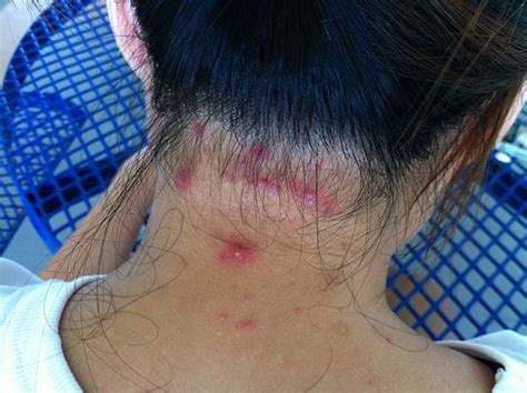 Mild Scalp Folliculitis