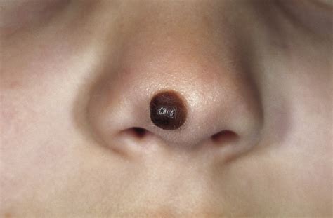 Congenital melanocytic nevus - Wikipedia