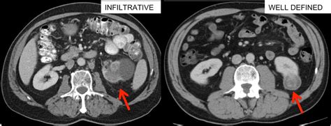 Kidney Cancer Diagnosis | Johns Hopkins Medicine