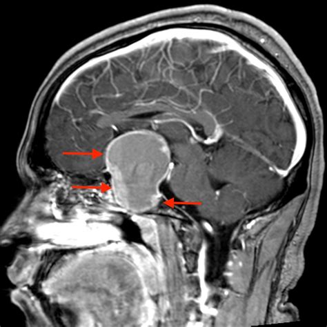 Prolactinoma - Endocrine - Medbullets Step 1