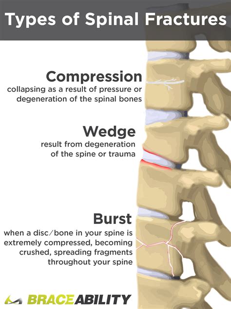 How Can I Treat a T12 or L1 Thoracic Spinal Burst Fracture?