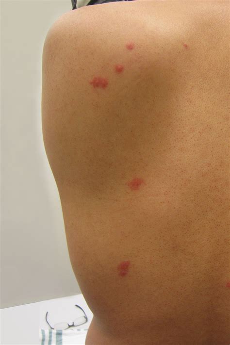 Bed Bug Bites Treatment In Philadelphia, PA 267-282-0022