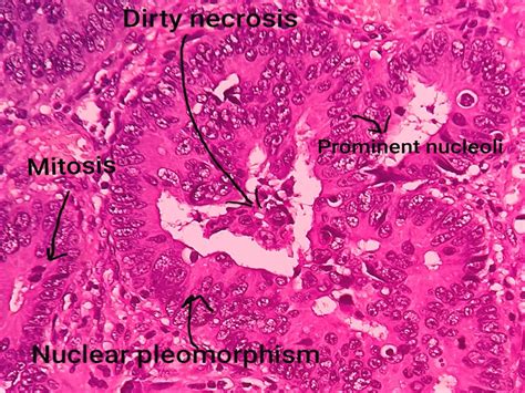 Adenocarcinoma Colon Histology