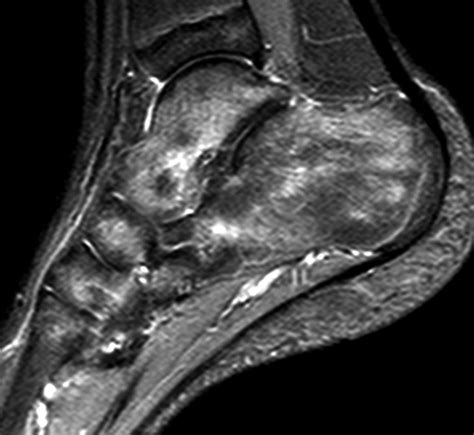 Bone Marrow Edema Patterns in the Ankle and Hindfoot: Distinguishing ...