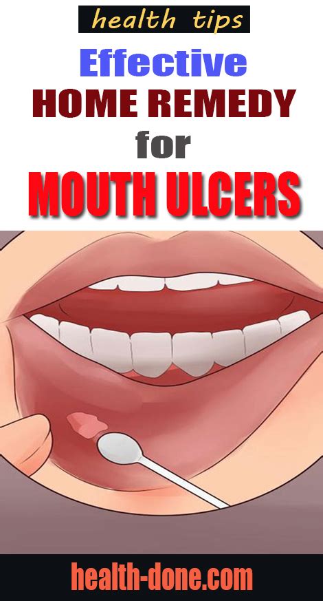 15 Home Remedies For Mouth Ulcers – Honey And Coconut Milk - Theraphy 2