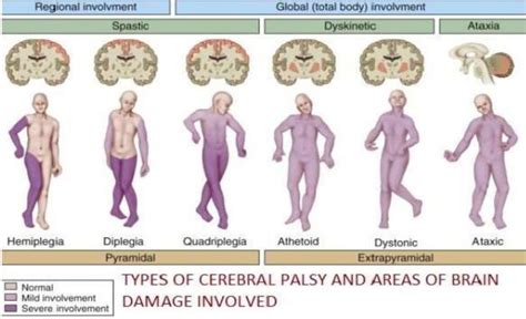 TYPES OF CEREBRAL PLASY | Download Scientific Diagram