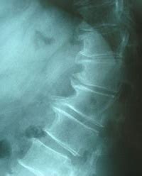 Spondylosis - Wikiwand