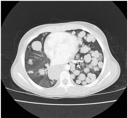 Pathology Outlines - Metastastic tumors to lung