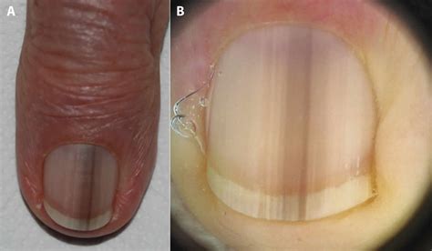 Melanonychia definition, causes, clinical features, diagnosis & treatment