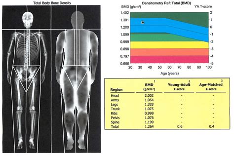 Bone Density Scan Results : Bone Densitometry/DEXA scan - Carlsbad ...