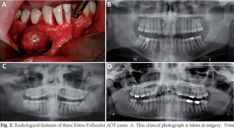 Figure 2 from Adenomatoid odontogenic tumor: Case series of 14 with ...