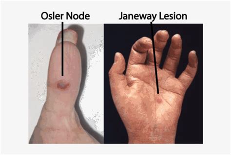 Janeway And Osler - Janeway Lesions And Osler's Nodes - 620x479 PNG ...