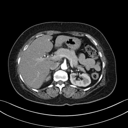 Normal Pancreas Cat Scan